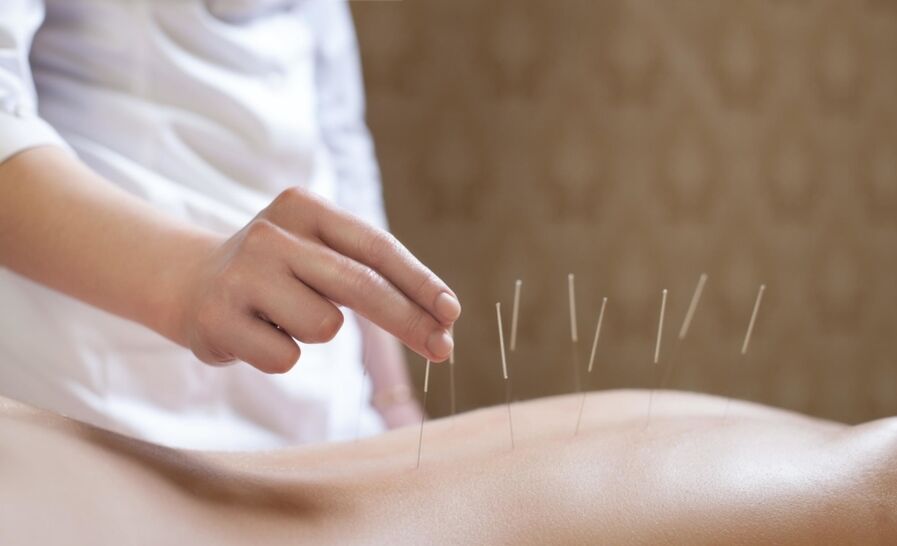 acupuntura